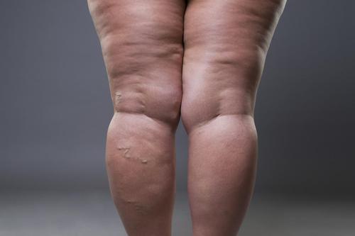 Lipedema: Mistaken for Obesity